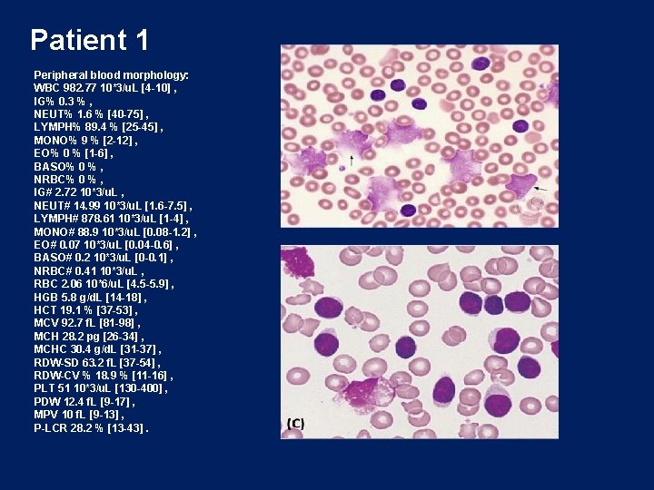 Patient 1 Peripheral blood morphology: WBC 982. 77 10*3/u. L [4 -10] , IG%