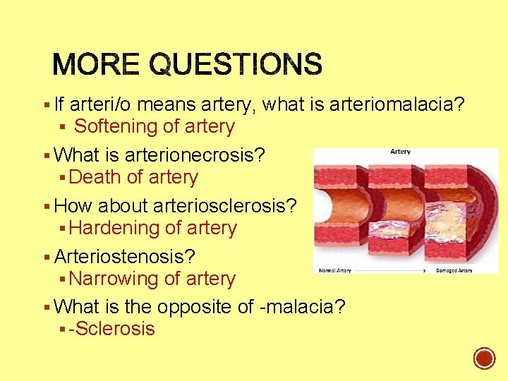 § If arteri/o means artery, what is arteriomalacia? § Softening of artery § What