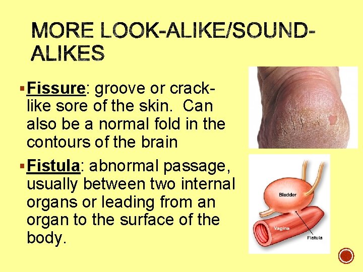 § Fissure: groove or crack- like sore of the skin. Can also be a