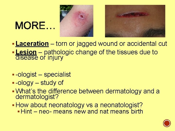 § Laceration – torn or jagged wound or accidental cut § Lesion – pathologic