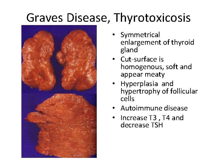 Graves Disease, Thyrotoxicosis • Symmetrical enlargement of thyroid gland • Cut-surface is homogenous, soft Graves Disease, Thyrotoxicosis • Symmetrical enlargement of thyroid gland • Cut-surface is homogenous, soft