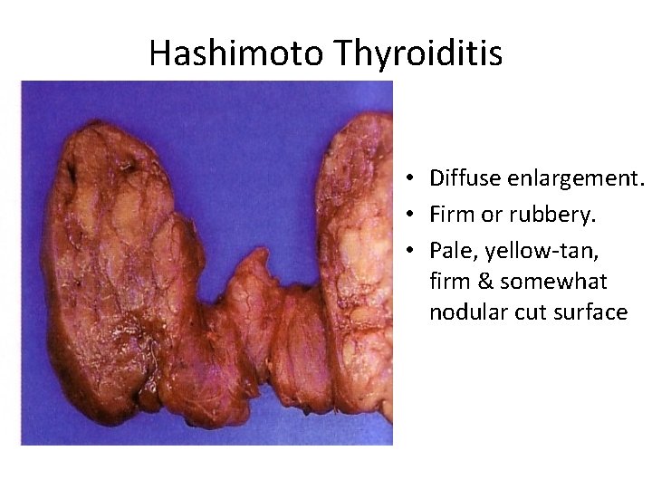 Hashimoto Thyroiditis • Diffuse enlargement. • Firm or rubbery. • Pale, yellow-tan, firm & Hashimoto Thyroiditis • Diffuse enlargement. • Firm or rubbery. • Pale, yellow-tan, firm &