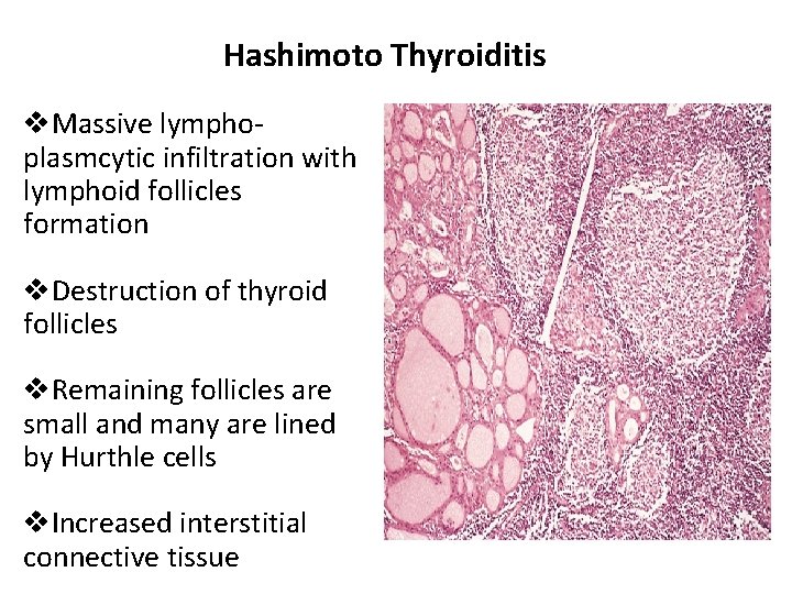 Hashimoto Thyroiditis v. Massive lymphoplasmcytic infiltration with lymphoid follicles formation v. Destruction of thyroid Hashimoto Thyroiditis v. Massive lymphoplasmcytic infiltration with lymphoid follicles formation v. Destruction of thyroid
