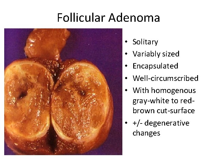 Follicular Adenoma Solitary Variably sized Encapsulated Well-circumscribed With homogenous gray-white to redbrown cut-surface • Follicular Adenoma Solitary Variably sized Encapsulated Well-circumscribed With homogenous gray-white to redbrown cut-surface •