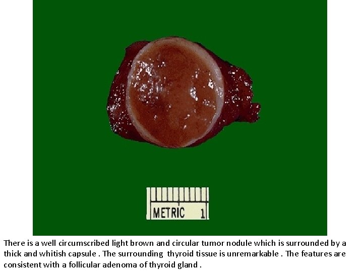 There is a well circumscribed light brown and circular tumor nodule which is surrounded There is a well circumscribed light brown and circular tumor nodule which is surrounded