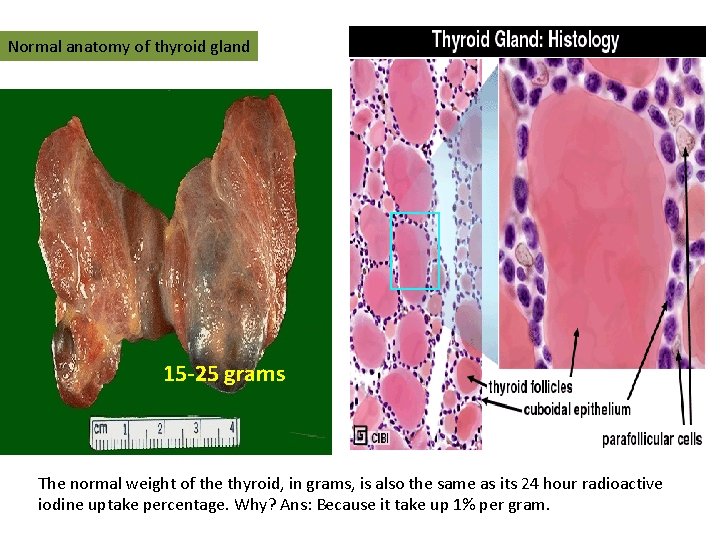 Normal anatomy of thyroid gland 15 -25 grams The normal weight of the thyroid, Normal anatomy of thyroid gland 15 -25 grams The normal weight of the thyroid,