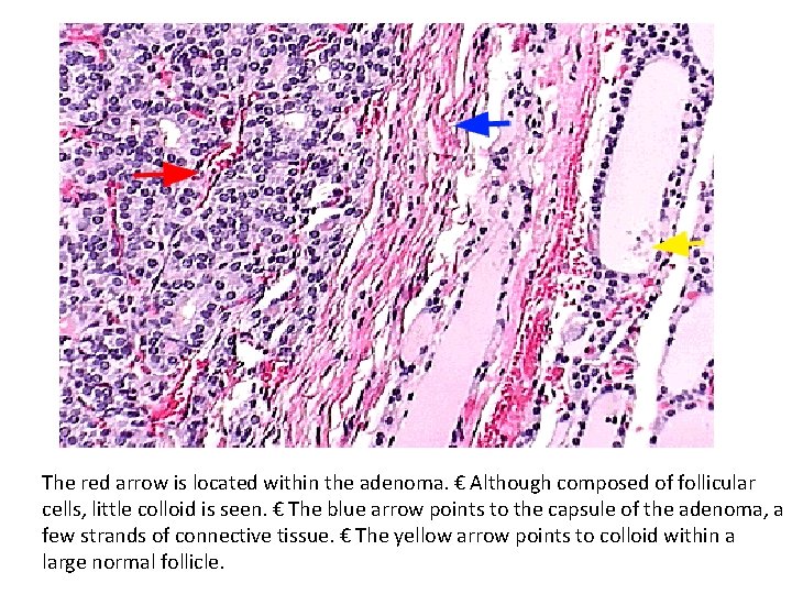 The red arrow is located within the adenoma. € Although composed of follicular cells, The red arrow is located within the adenoma. € Although composed of follicular cells,