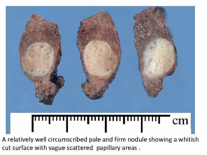 A relatively well circumscribed pale and firm nodule showing a whitish cut surface with A relatively well circumscribed pale and firm nodule showing a whitish cut surface with