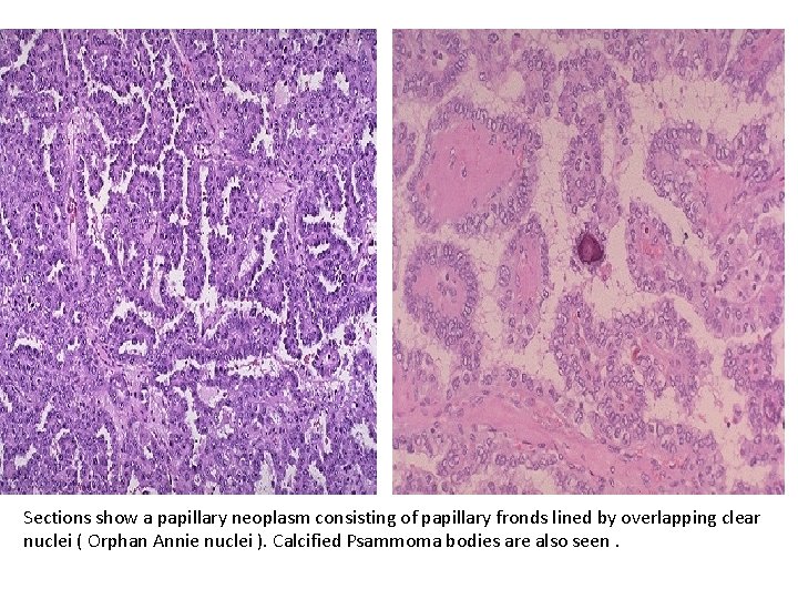Sections show a papillary neoplasm consisting of papillary fronds lined by overlapping clear nuclei Sections show a papillary neoplasm consisting of papillary fronds lined by overlapping clear nuclei