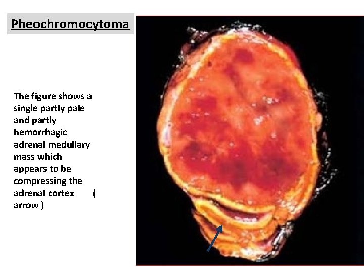 Pheochromocytoma The figure shows a single partly pale and partly hemorrhagic adrenal medullary mass Pheochromocytoma The figure shows a single partly pale and partly hemorrhagic adrenal medullary mass