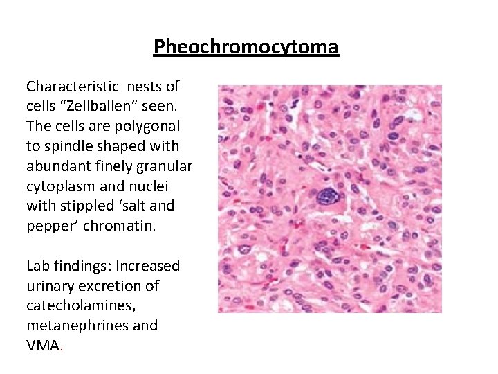 Pheochromocytoma Characteristic nests of cells “Zellballen” seen. The cells are polygonal to spindle shaped Pheochromocytoma Characteristic nests of cells “Zellballen” seen. The cells are polygonal to spindle shaped