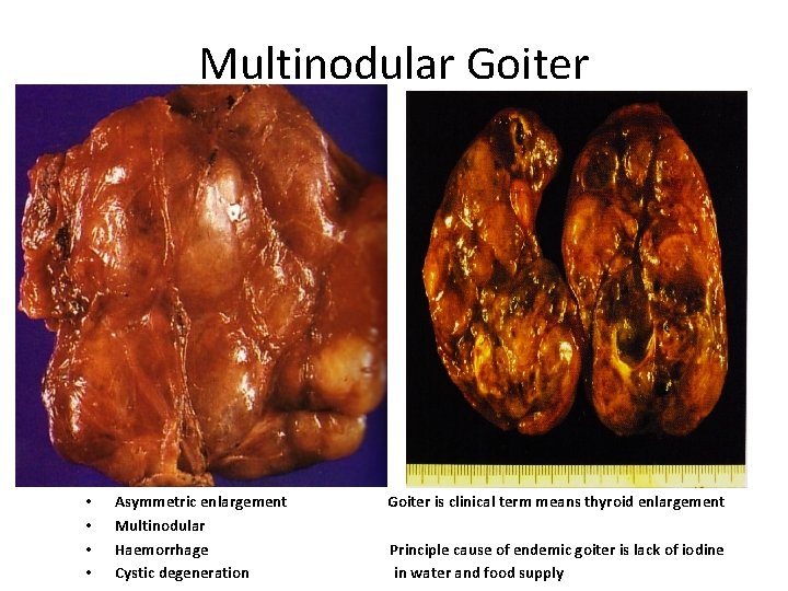 Multinodular Goiter • • Asymmetric enlargement Multinodular Haemorrhage Cystic degeneration Goiter is clinical term Multinodular Goiter • • Asymmetric enlargement Multinodular Haemorrhage Cystic degeneration Goiter is clinical term