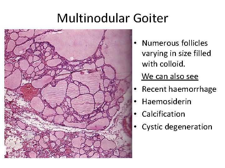 Multinodular Goiter • Numerous follicles varying in size filled with colloid. We can also Multinodular Goiter • Numerous follicles varying in size filled with colloid. We can also