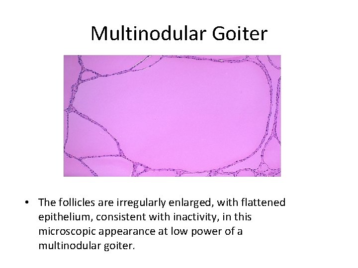 Multinodular Goiter • The follicles are irregularly enlarged, with flattened epithelium, consistent with inactivity, Multinodular Goiter • The follicles are irregularly enlarged, with flattened epithelium, consistent with inactivity,