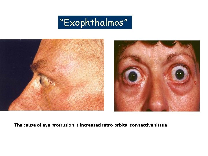 “Exophthalmos” The cause of eye protrusion is Increased retro-orbital connective tissue “Exophthalmos” The cause of eye protrusion is Increased retro-orbital connective tissue