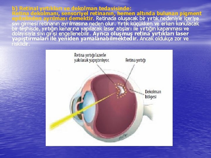 b) Retinal yırtıkları ve dekolman tedavisinde: Retina dekolmanı, sensoriyel retinanın, hemen altında bulunan pigment