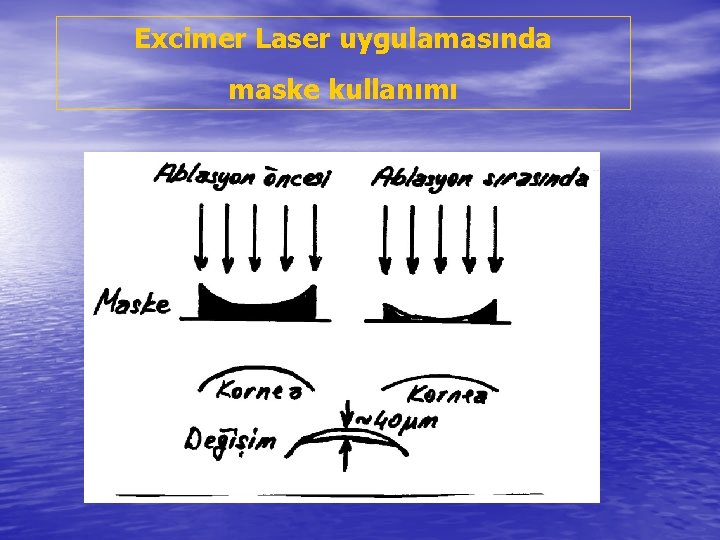 Excimer Laser uygulamasında maske kullanımı 