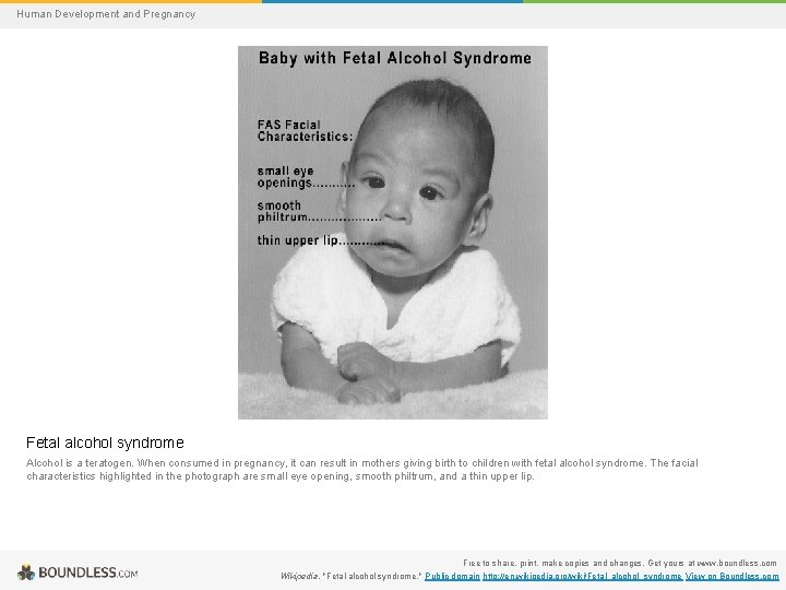 Human Development and Pregnancy Fetal alcohol syndrome Alcohol is a teratogen. When consumed in