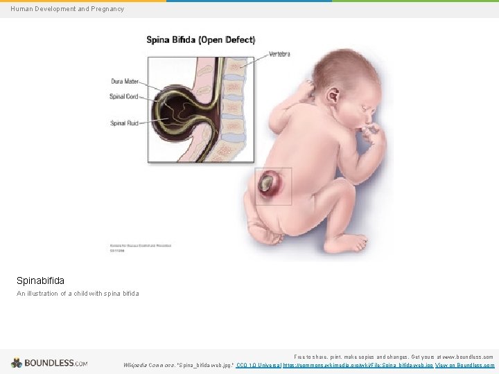 Human Development and Pregnancy Spinabifida An illustration of a child with spina bifida Free