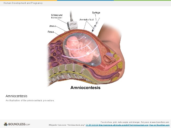 Human Development and Pregnancy Amniocentesis An illustration of the amniocentesis procedure. Free to share,