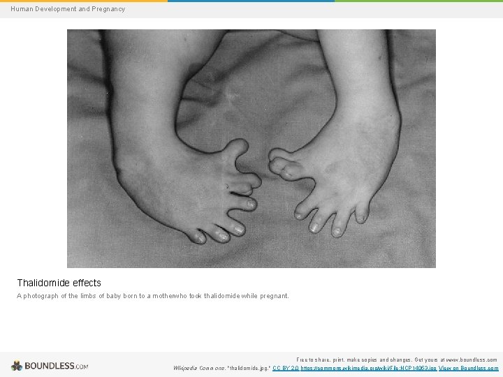 Human Development and Pregnancy Thalidomide effects A photograph of the limbs of baby born
