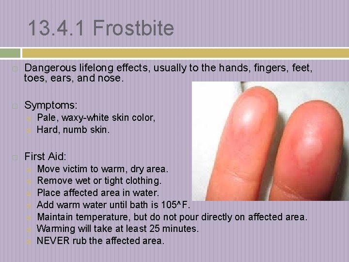 13. 4. 1 Frostbite Dangerous lifelong effects, usually to the hands, fingers, feet, toes,