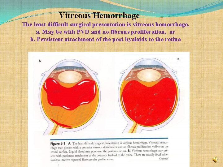 Vitreous Hemorrhage The least difficult surgical presentation is vitreous hemorrhage. a. May be with