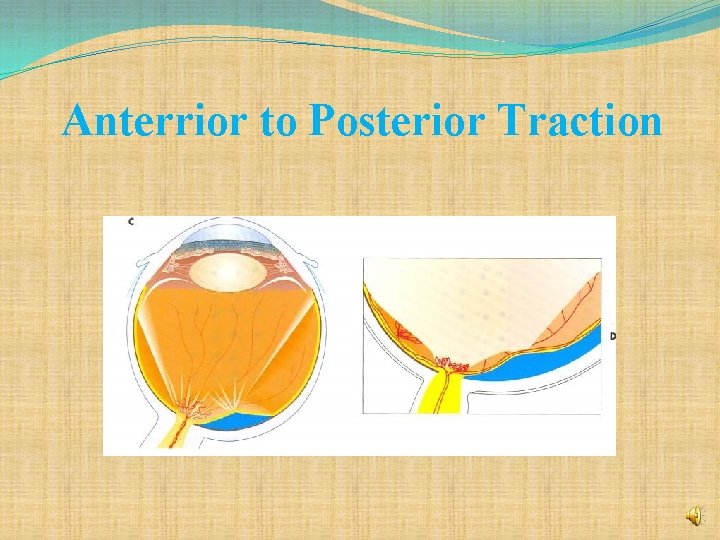 Anterrior to Posterior Traction 