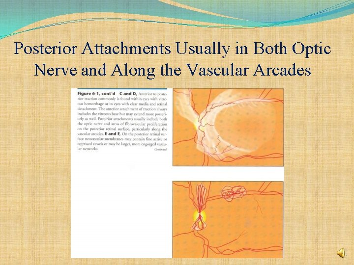 Posterior Attachments Usually in Both Optic Nerve and Along the Vascular Arcades 