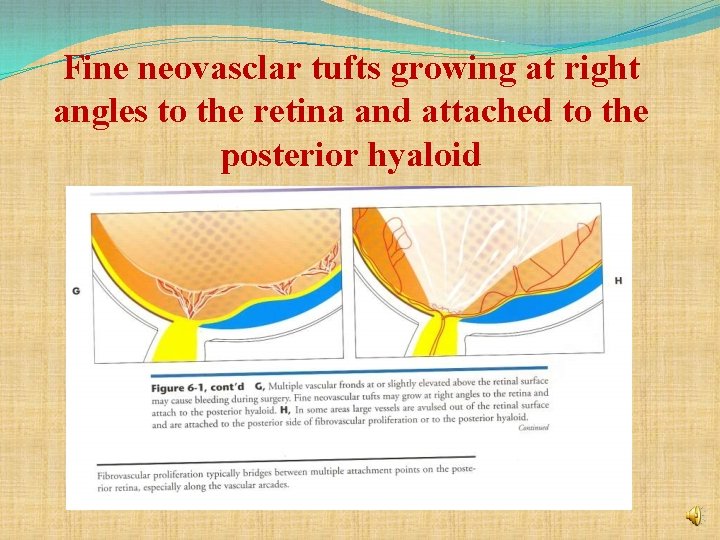Fine neovasclar tufts growing at right angles to the retina and attached to the