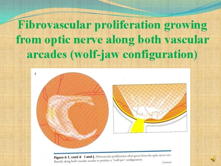 Fibrovascular proliferation growing from optic nerve along both vascular arcades (wolf-jaw configuration) 