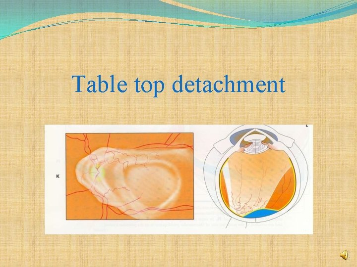 Table top detachment 