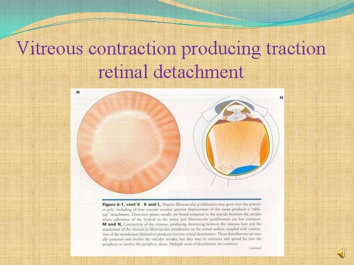 Vitreous contraction producing traction retinal detachment 