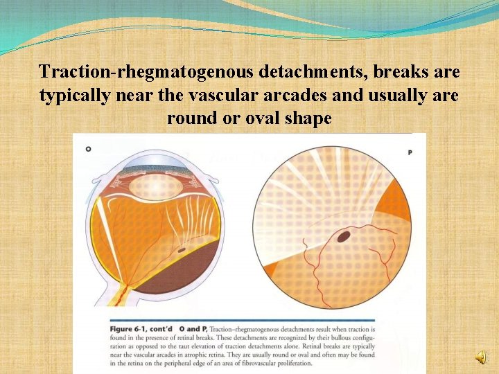 Traction-rhegmatogenous detachments, breaks are typically near the vascular arcades and usually are round or