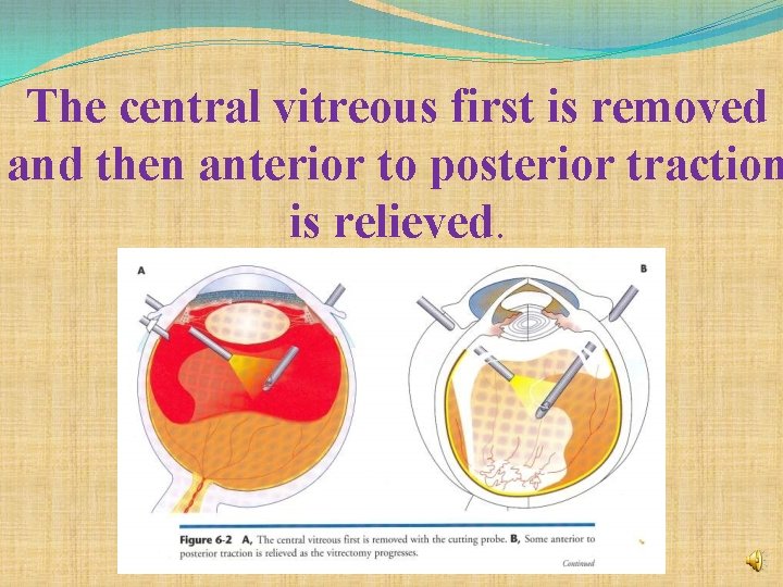 The central vitreous first is removed and then anterior to posterior traction is relieved.