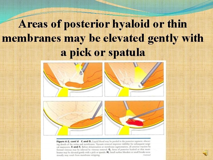 Areas of posterior hyaloid or thin membranes may be elevated gently with a pick