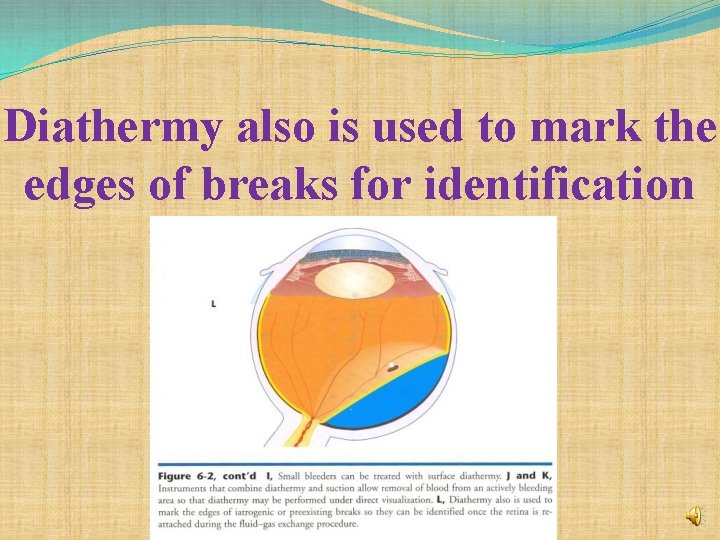 Diathermy also is used to mark the edges of breaks for identification 
