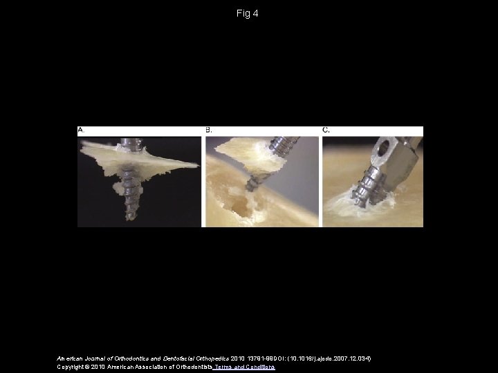 Fig 4 American Journal of Orthodontics and Dentofacial Orthopedics 2010 13791 -99 DOI: (10.