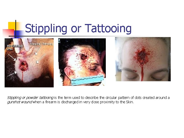 Stippling or Tattooing Stippling or powder tattooing is the term used to describe the