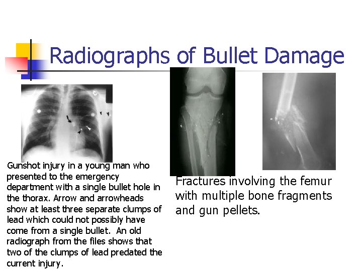 Radiographs of Bullet Damage Gunshot injury in a young man who presented to the