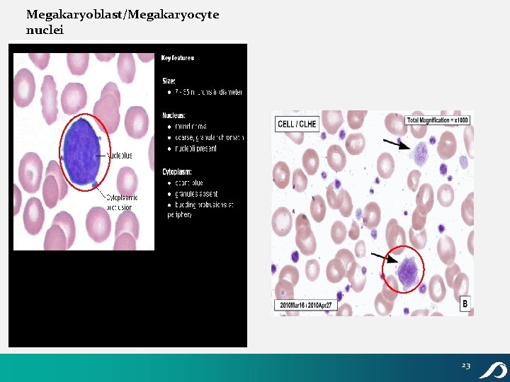 Megakaryoblast/Megakaryocyte nuclei 23 