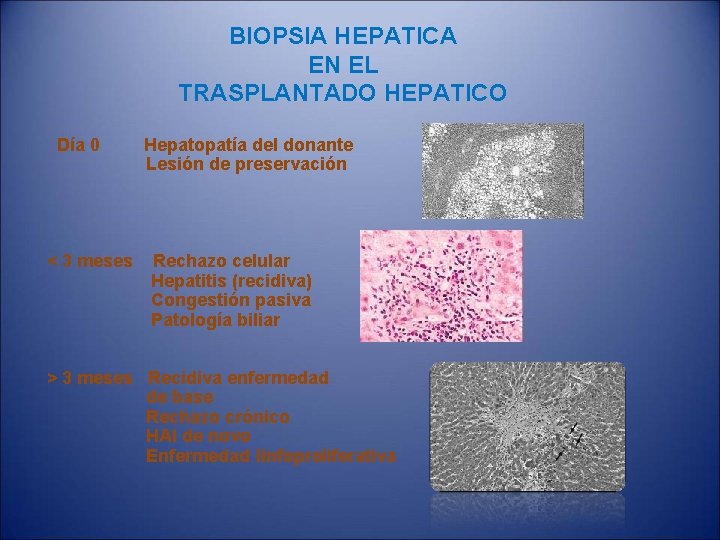 BIOPSIA HEPATICA EN EL TRASPLANTADO HEPATICO Día 0 < 3 meses Hepatopatía del donante