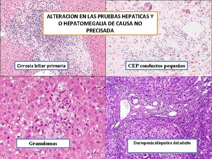 ALTERACION EN LAS PRUEBAS HEPATICAS Y O HEPATOMEGALIA DE CAUSA NO PRECISADA Cirrosis biliar