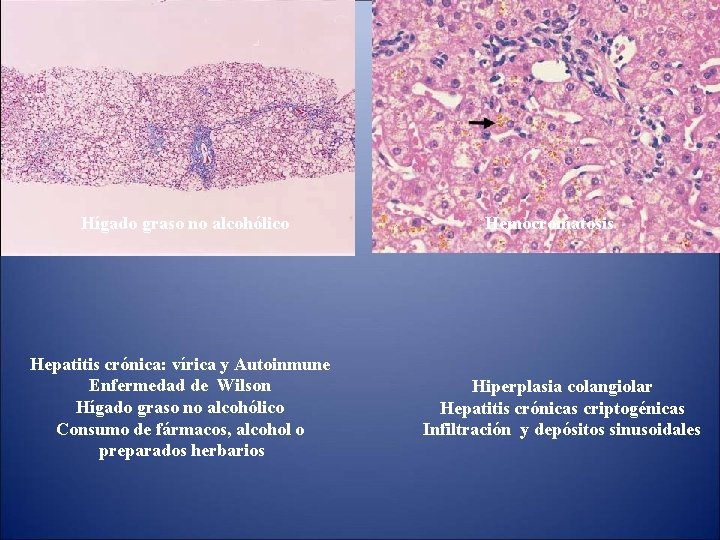 Hígado graso no alcohólico Hepatitis crónica: vírica y Autoinmune Enfermedad de Wilson Hígado graso