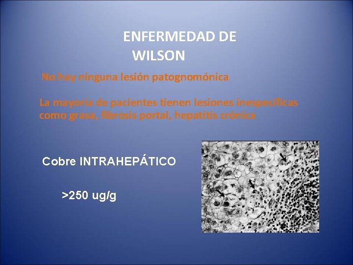 ENFERMEDAD DE WILSON No hay ninguna lesión patognomónica La mayoría de pacientes tienen lesiones