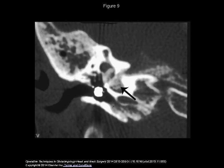 Figure 9 Operative Techniques in Otolaryngology-Head and Neck Surgery 2014 2513 -20 DOI: (10.