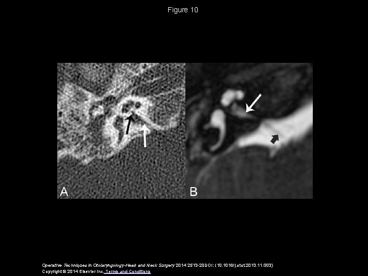 Figure 10 Operative Techniques in Otolaryngology-Head and Neck Surgery 2014 2513 -20 DOI: (10.