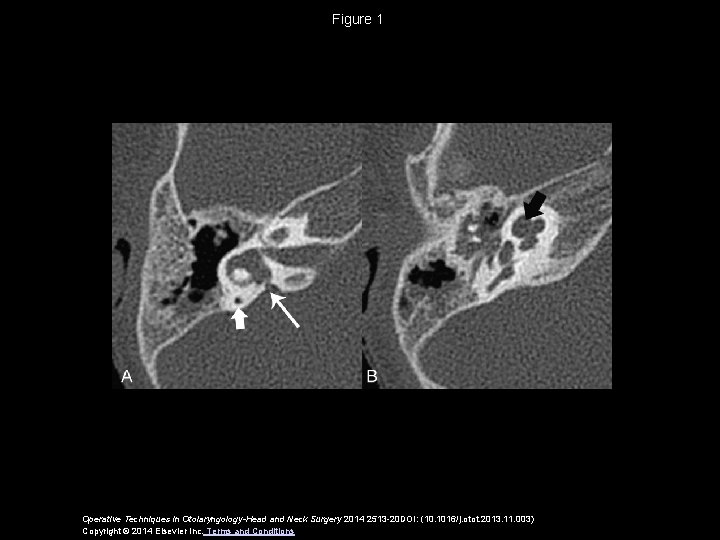 Figure 1 Operative Techniques in Otolaryngology-Head and Neck Surgery 2014 2513 -20 DOI: (10.