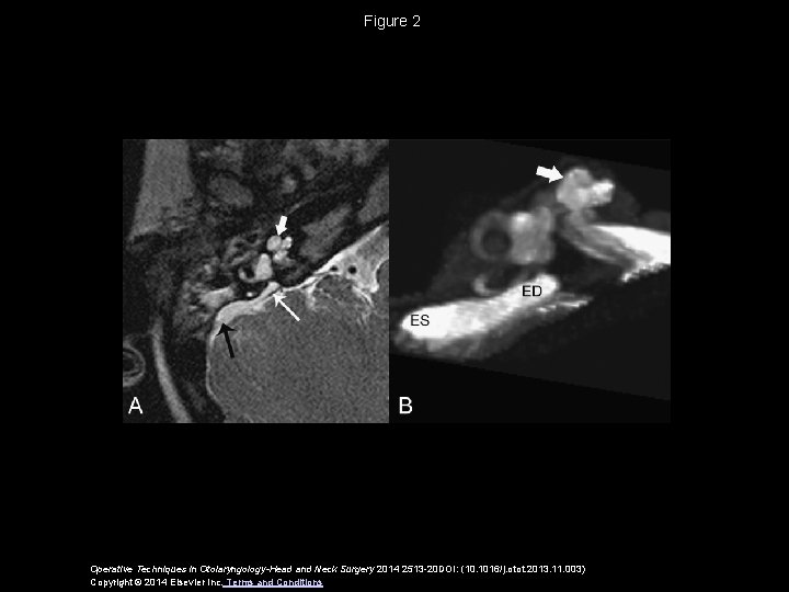 Figure 2 Operative Techniques in Otolaryngology-Head and Neck Surgery 2014 2513 -20 DOI: (10.
