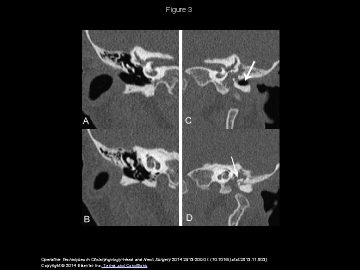 Figure 3 Operative Techniques in Otolaryngology-Head and Neck Surgery 2014 2513 -20 DOI: (10.